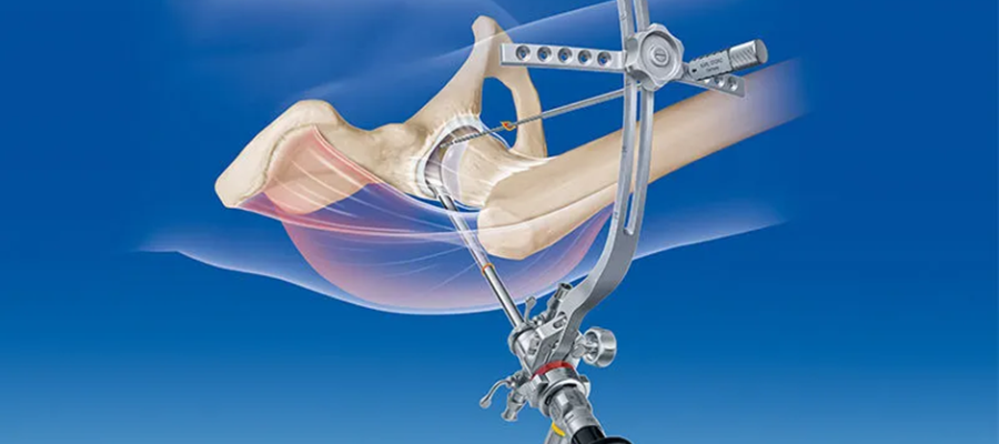Hip Arthroscopy